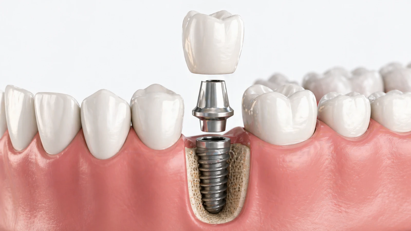 Dental Implant